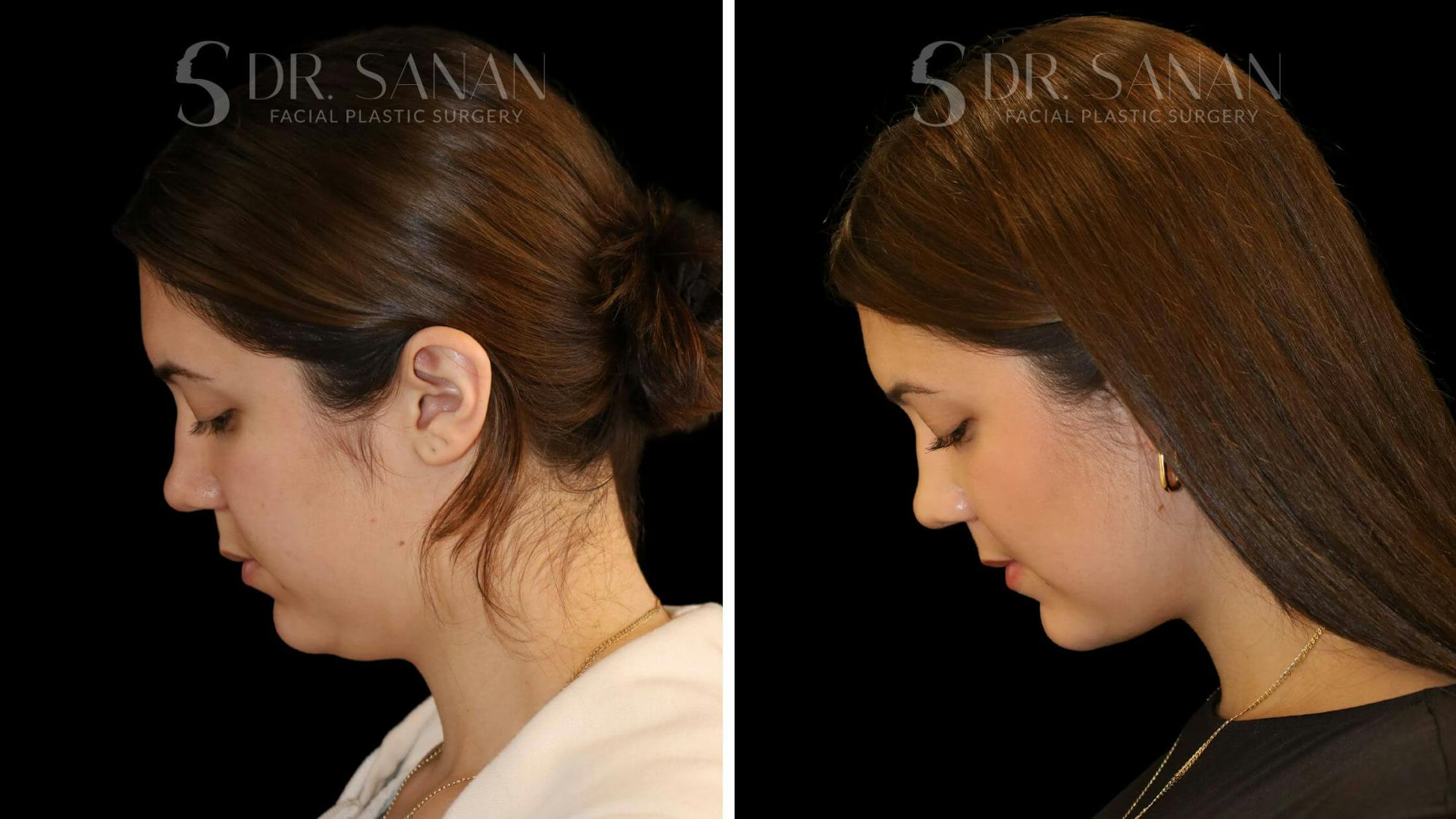 Neck Lift Before & After Gallery - Patient 109948 - Image 5