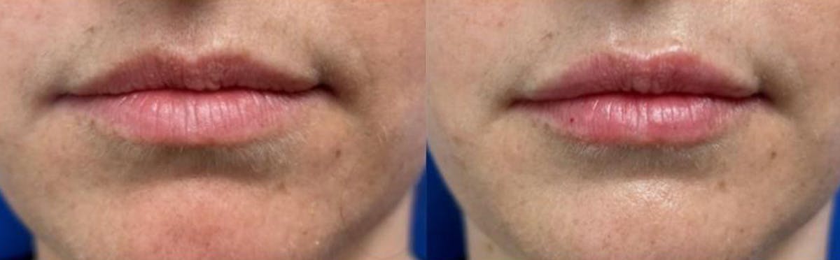 Lip Augmentation Before & After Gallery - Patient 294759 - Image 1