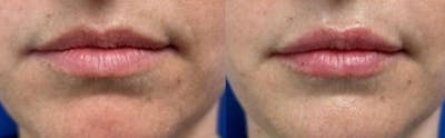 Lip Augmentation Before & After Gallery - Patient 294759 - Image 1