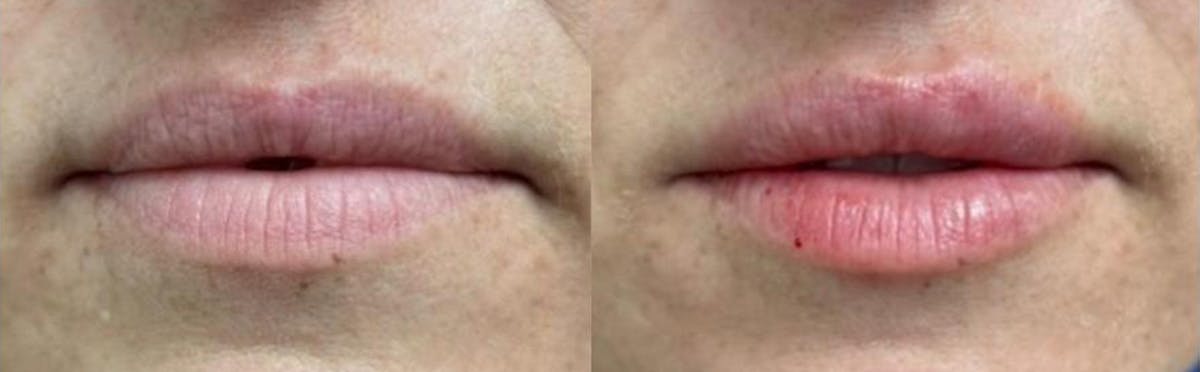 Lip Augmentation Before & After Gallery - Patient 100519 - Image 1