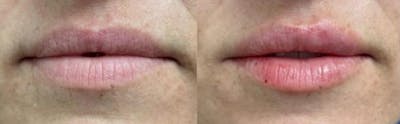 Lip Augmentation Before & After Gallery - Patient 100519 - Image 1