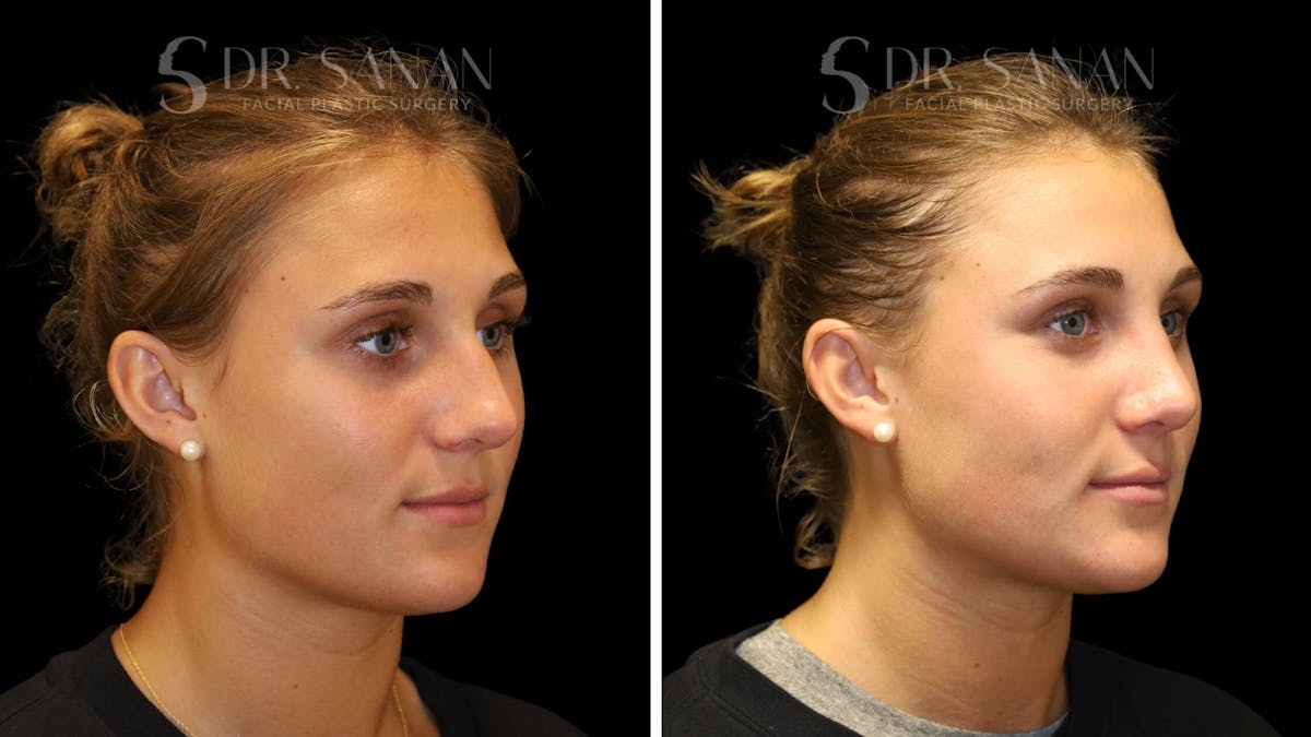 Rhinoplasty Before & After Gallery - Patient 103950 - Image 3