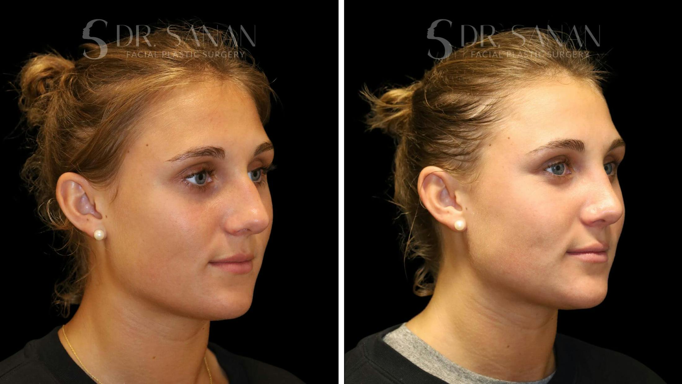 Rhinoplasty Before & After Gallery - Patient 103950 - Image 3