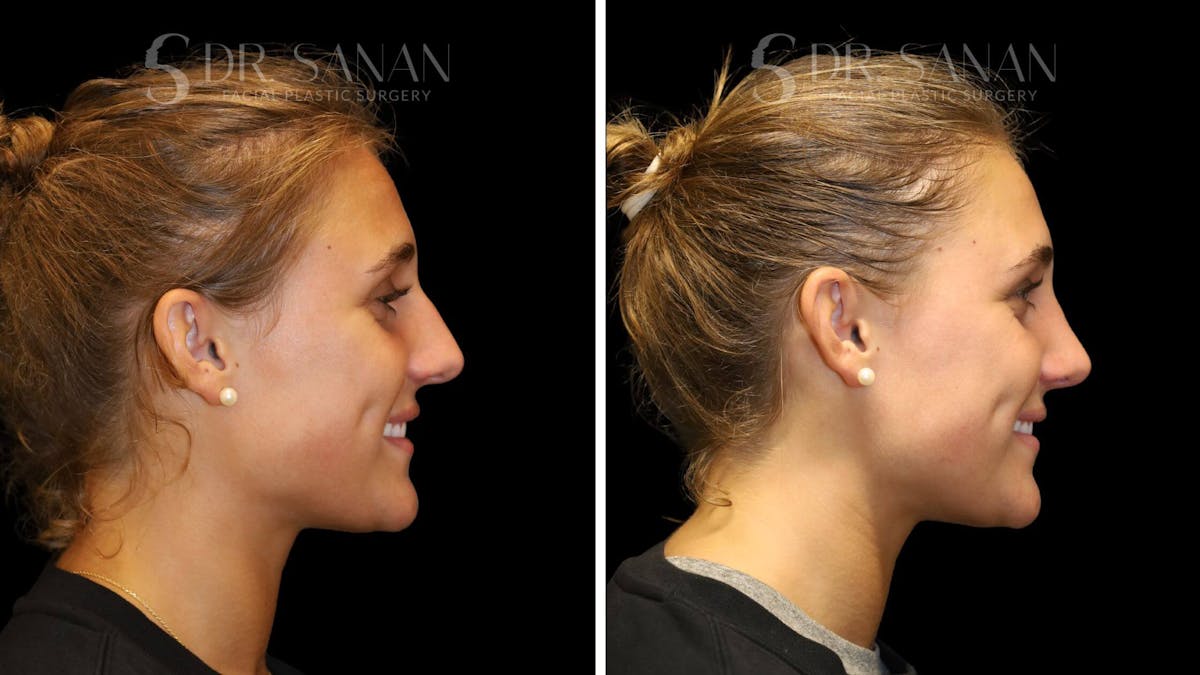 Rhinoplasty Before & After Gallery - Patient 103950 - Image 7