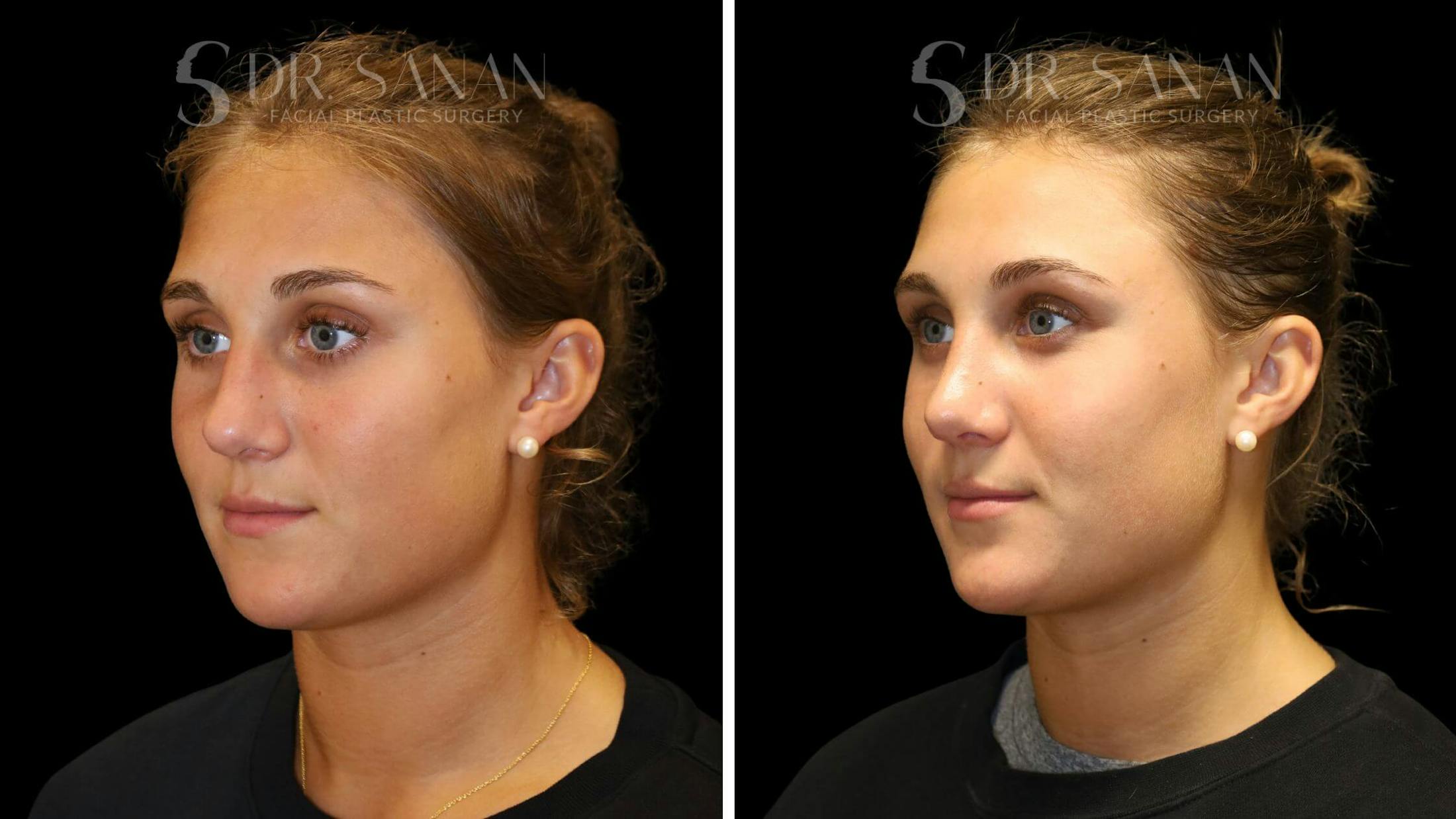 Rhinoplasty Before & After Gallery - Patient 103950 - Image 4