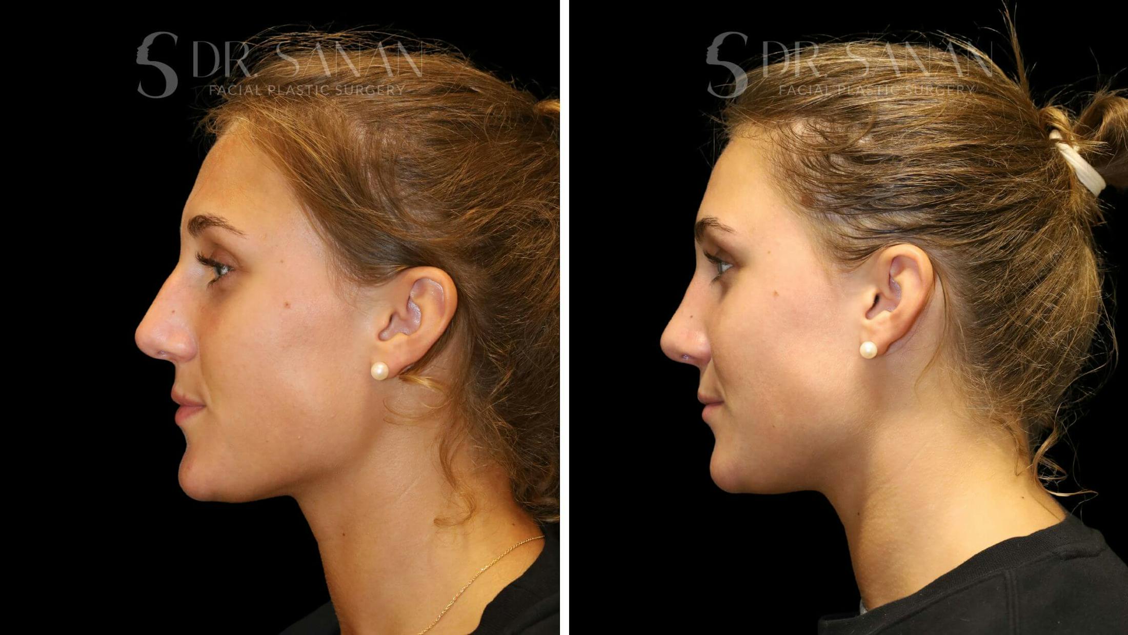 Rhinoplasty Before & After Gallery - Patient 103950 - Image 2