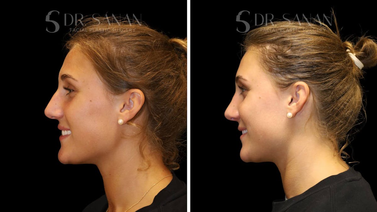 Rhinoplasty Before & After Gallery - Patient 103950 - Image 8