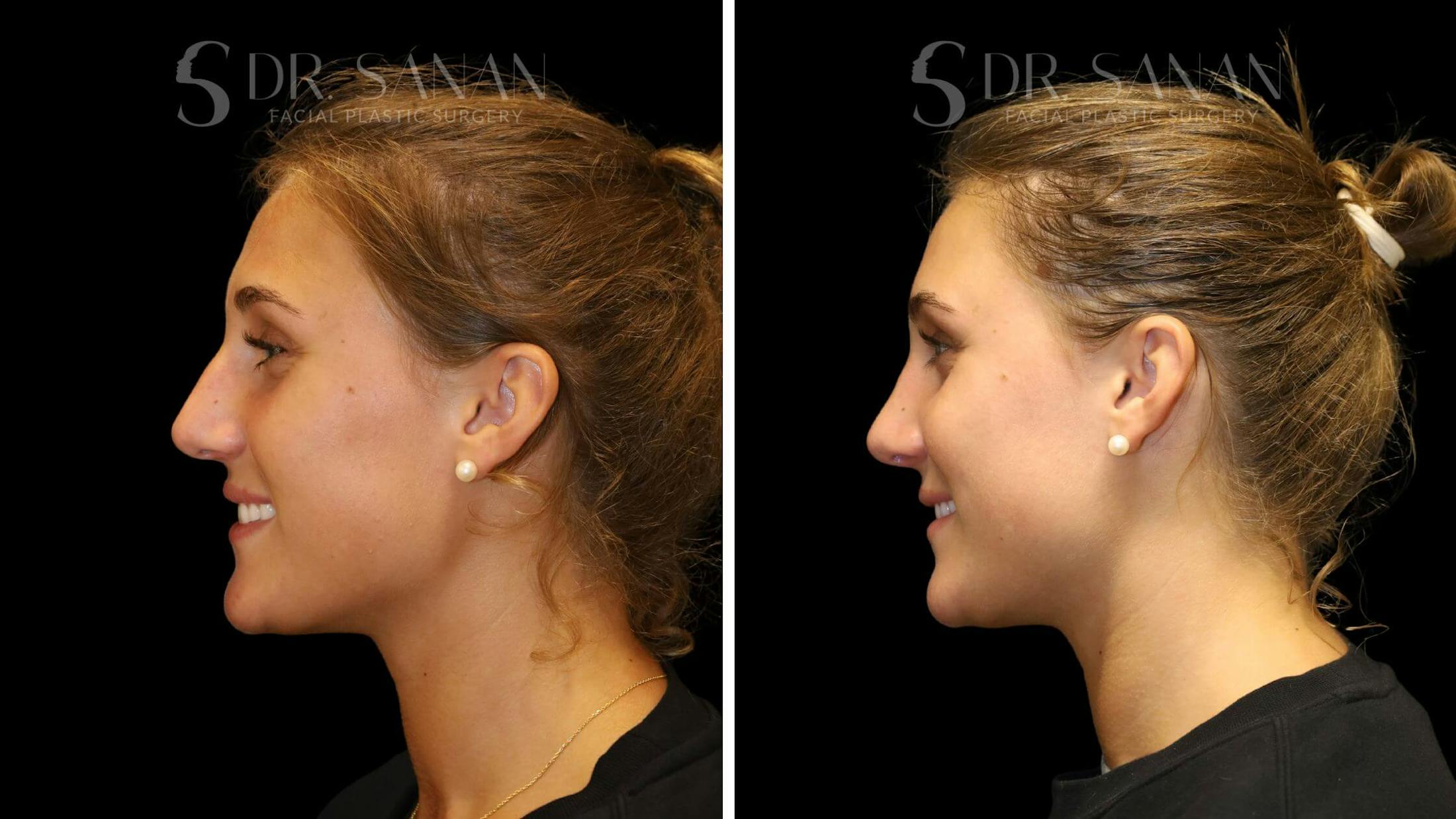 Rhinoplasty Before & After Gallery - Patient 103950 - Image 8