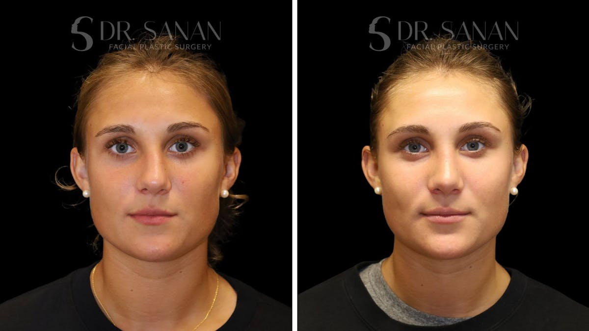 Rhinoplasty Before & After Gallery - Patient 103950 - Image 5