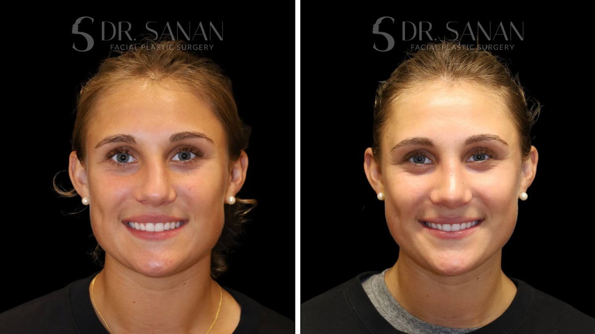 Rhinoplasty Before & After Gallery - Patient 103950 - Image 6