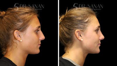 Rhinoplasty Before & After Gallery - Patient 103950 - Image 1