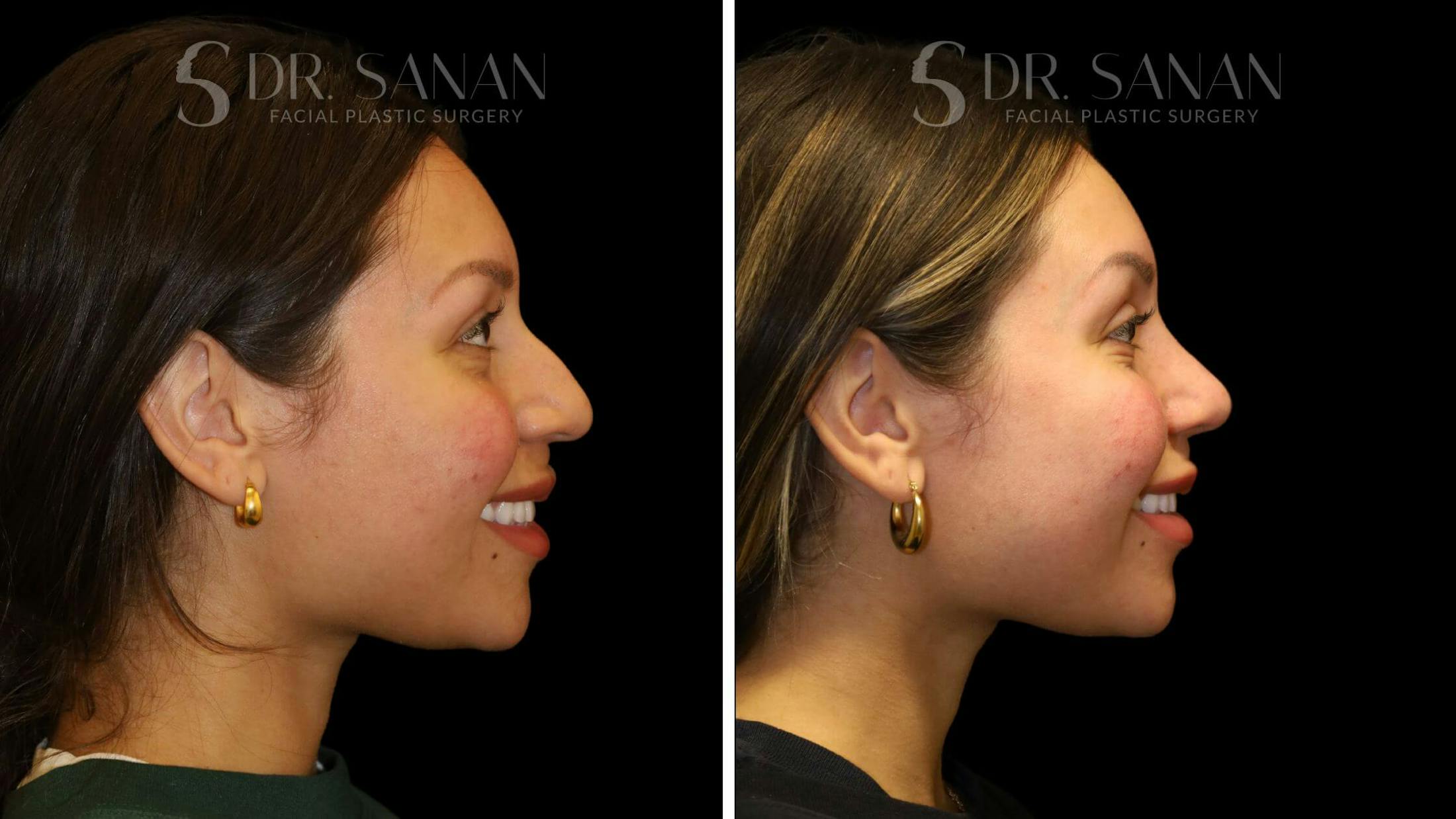 Rhinoplasty Before & After Gallery - Patient 111196 - Image 1