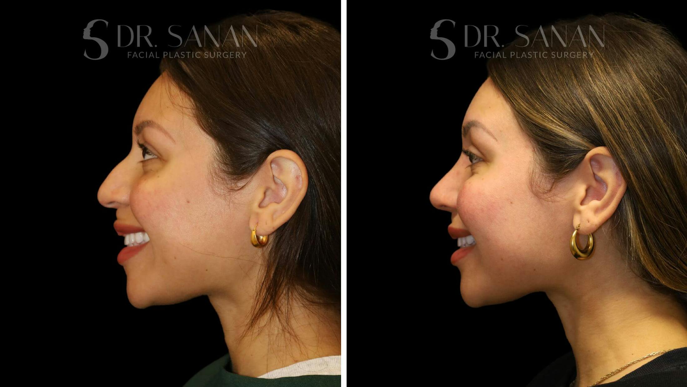 Rhinoplasty Before & After Gallery - Patient 111196 - Image 2