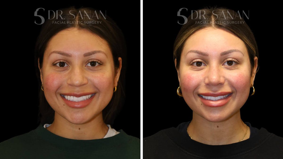 Rhinoplasty Before & After Gallery - Patient 111196 - Image 6