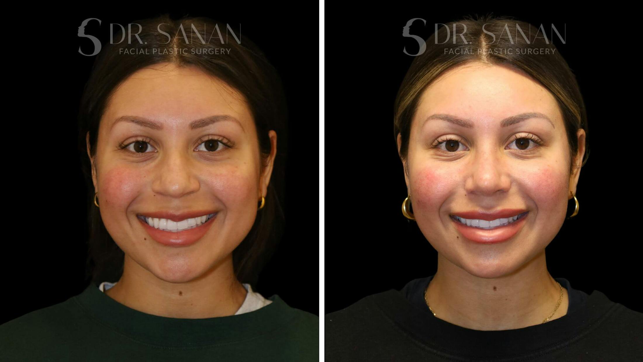 Rhinoplasty Before & After Gallery - Patient 111196 - Image 6