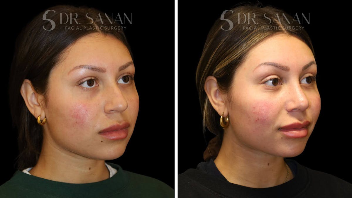 Rhinoplasty Before & After Gallery - Patient 111196 - Image 3