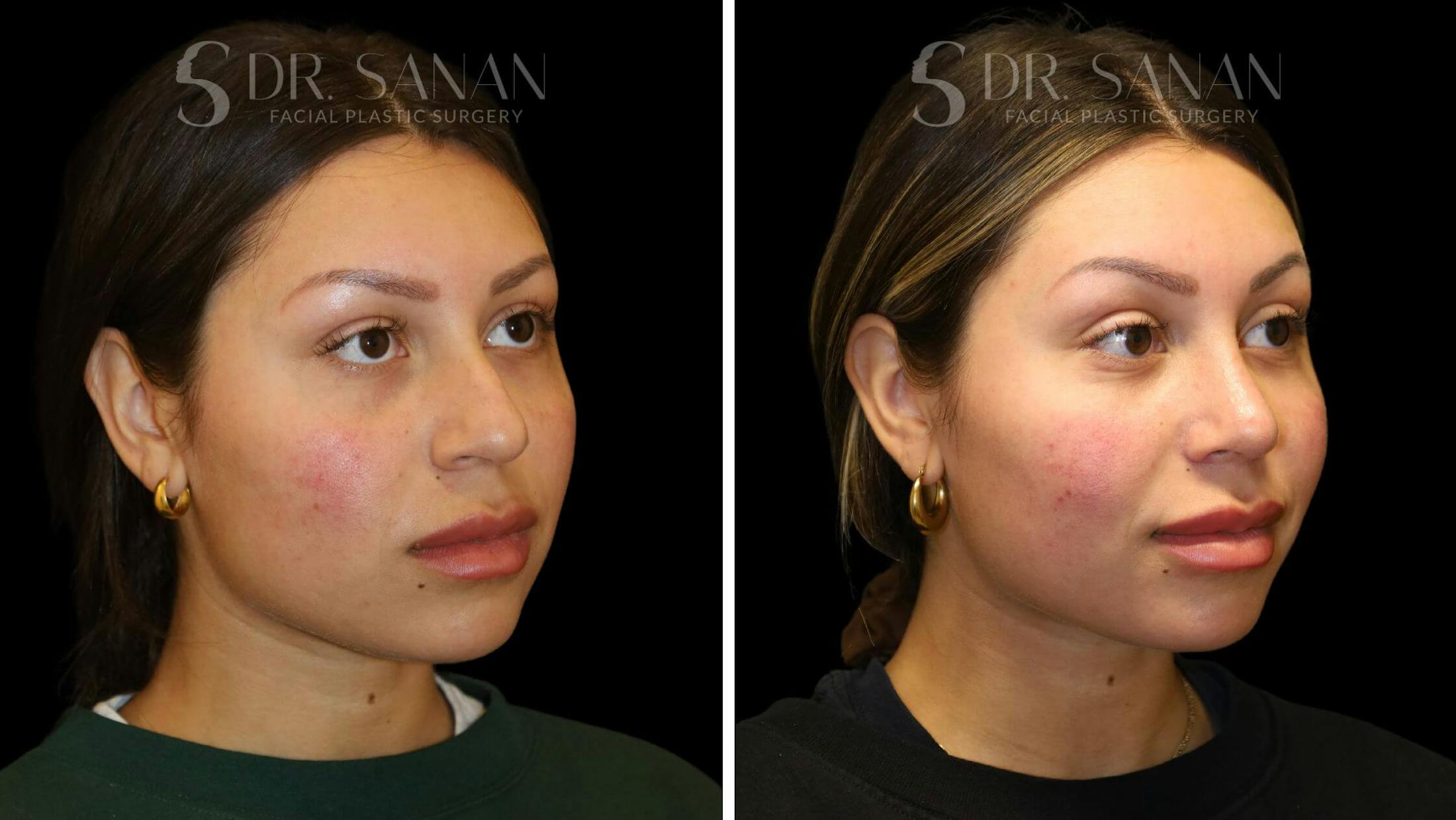 Rhinoplasty Before & After Gallery - Patient 111196 - Image 3