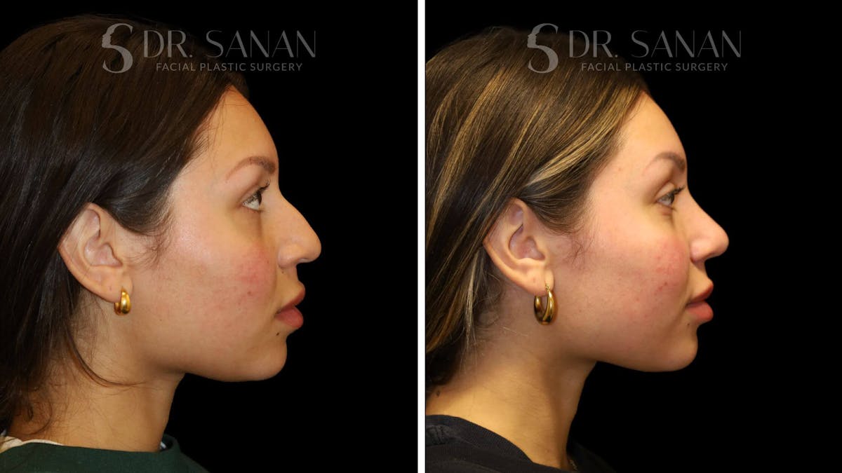 Rhinoplasty Before & After Gallery - Patient 111196 - Image 7