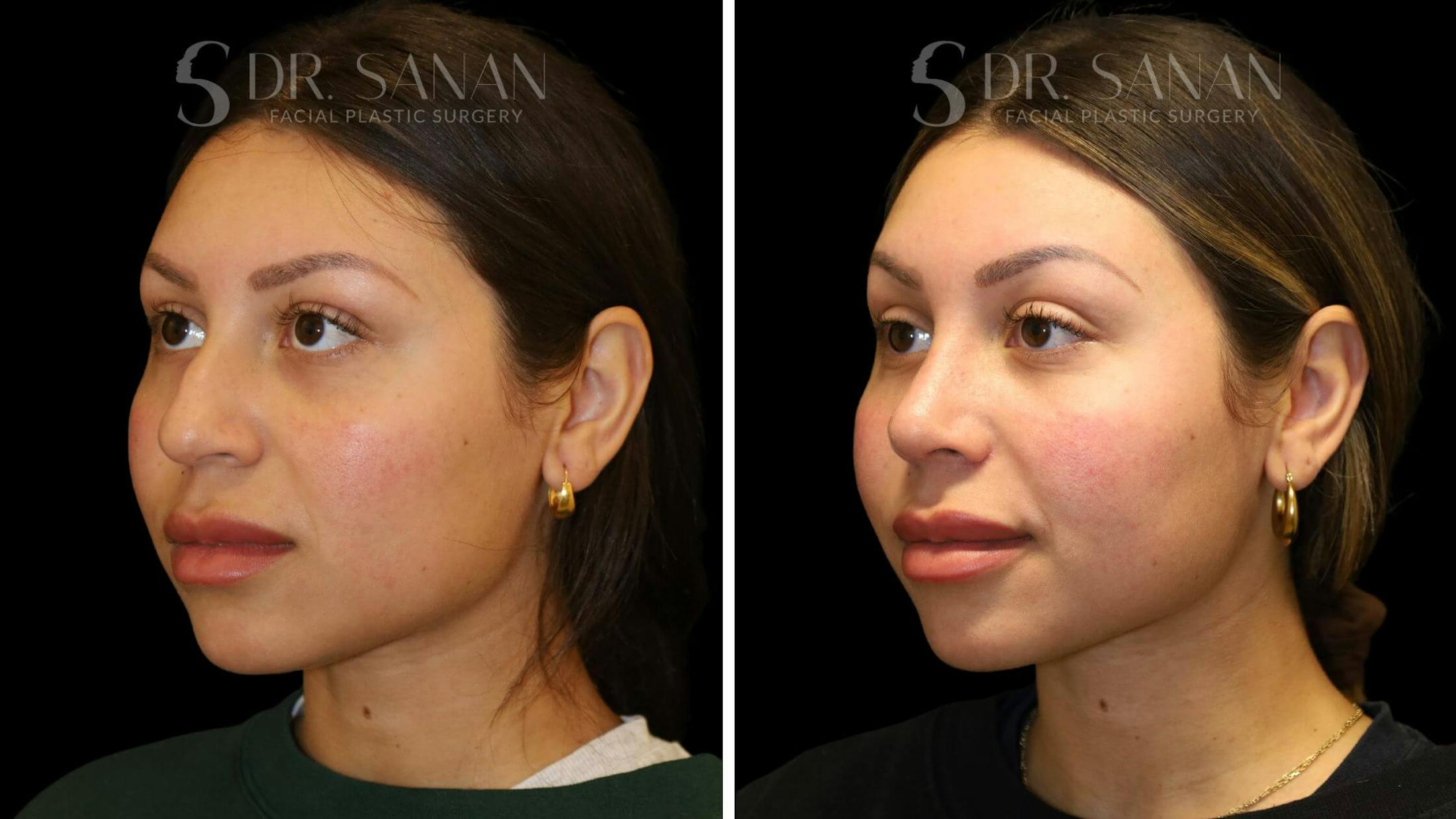Rhinoplasty Before & After Gallery - Patient 111196 - Image 4