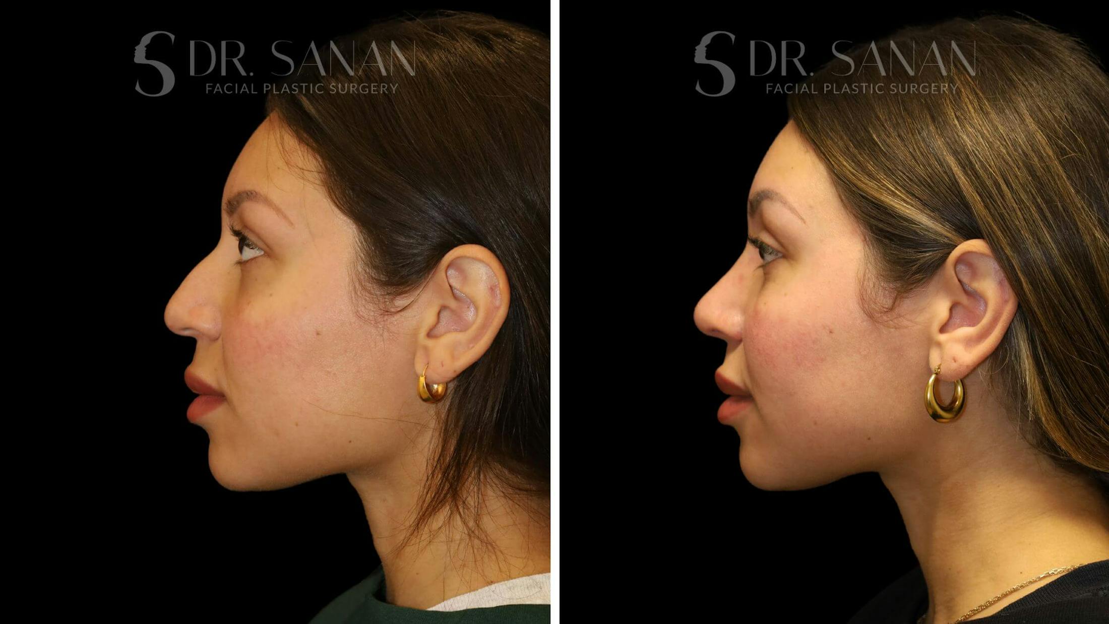 Rhinoplasty Before & After Gallery - Patient 111196 - Image 8