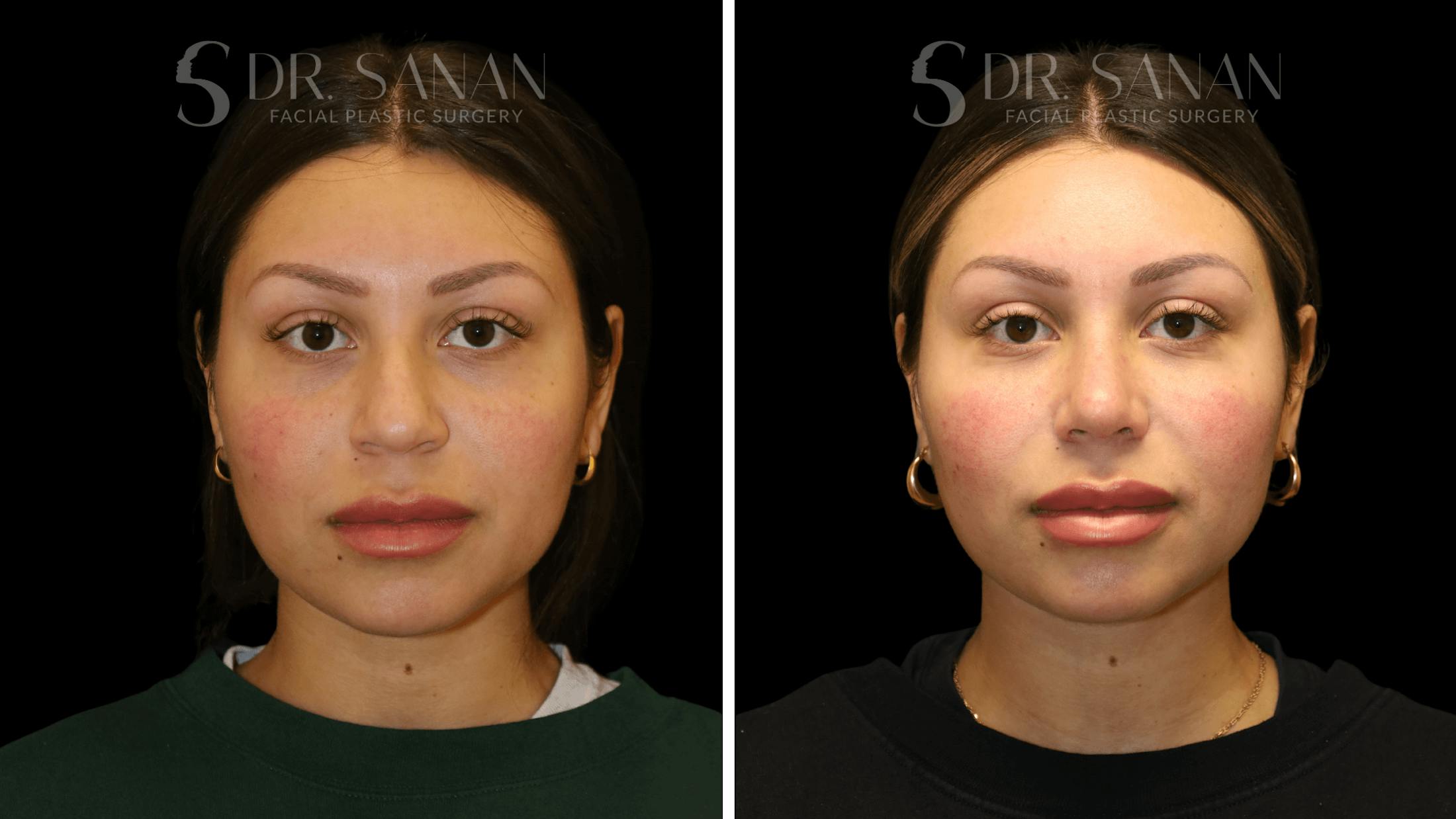 Rhinoplasty Before & After Gallery - Patient 111196 - Image 5