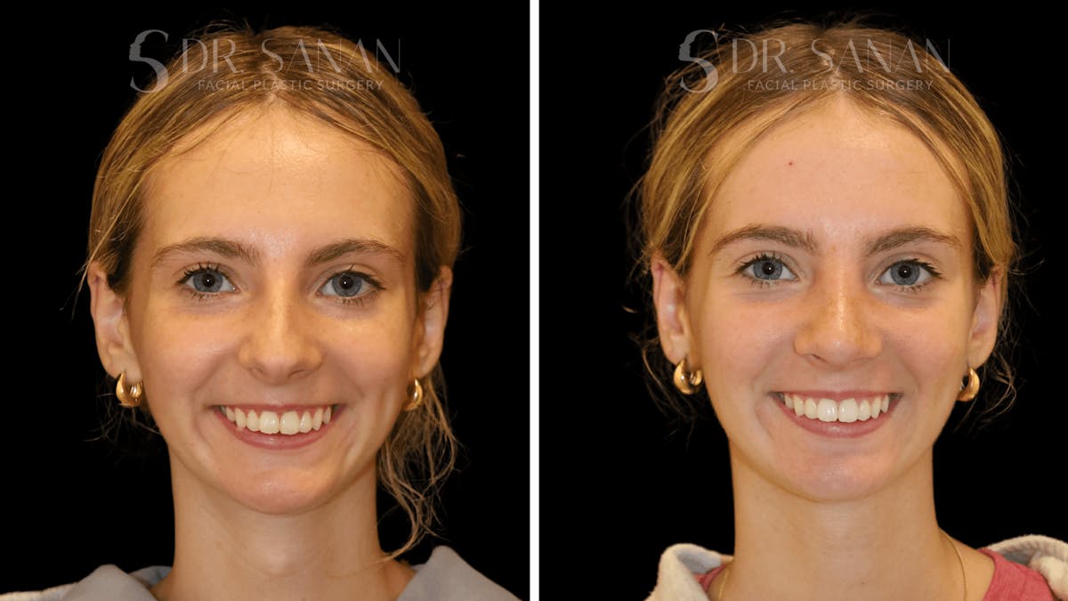 Rhinoplasty Before & After Gallery - Patient 388107 - Image 7