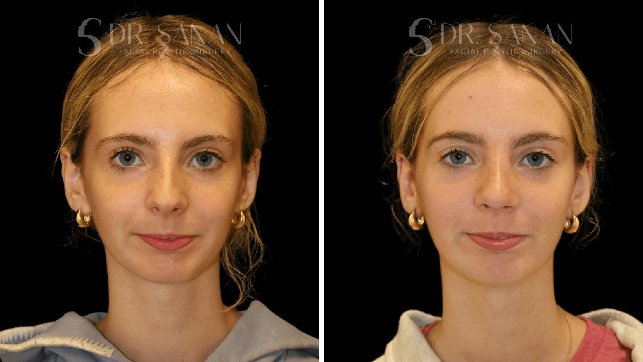 Rhinoplasty Before & After Gallery - Patient 388107 - Image 8