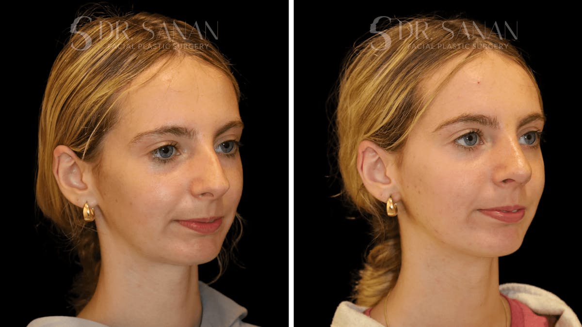 Rhinoplasty Before & After Gallery - Patient 388107 - Image 5
