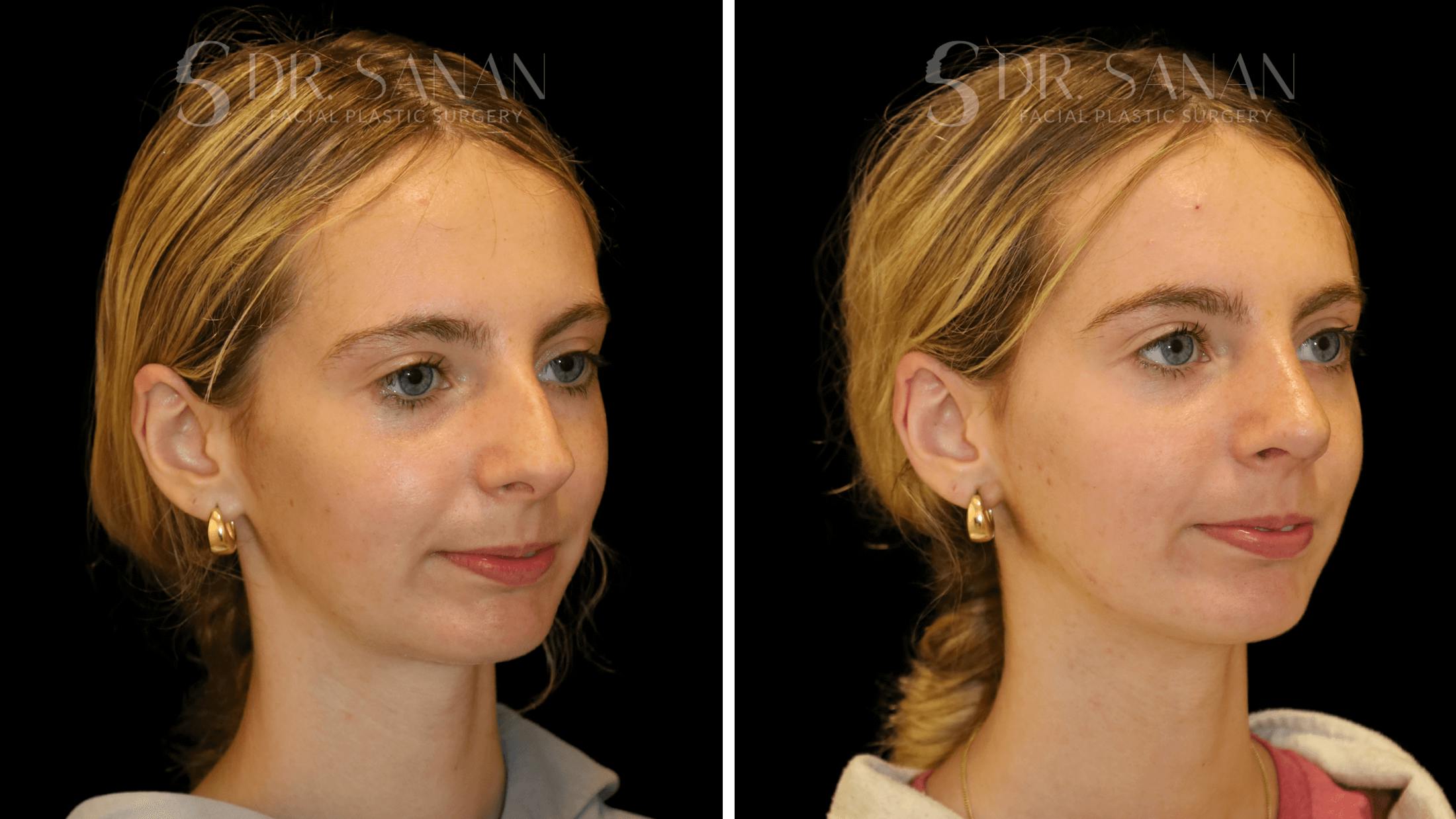 Rhinoplasty Before & After Gallery - Patient 388107 - Image 5