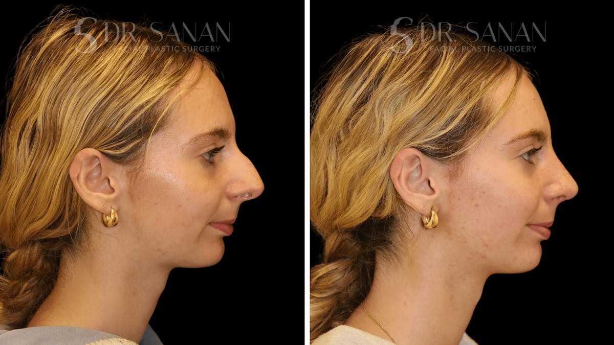 Rhinoplasty Before & After Gallery - Patient 388107 - Image 1