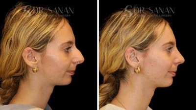 Rhinoplasty Before & After Gallery - Patient 388107 - Image 1
