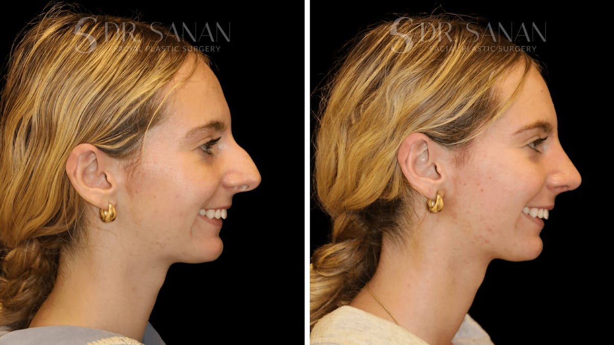 Rhinoplasty Before & After Gallery - Patient 388107 - Image 4