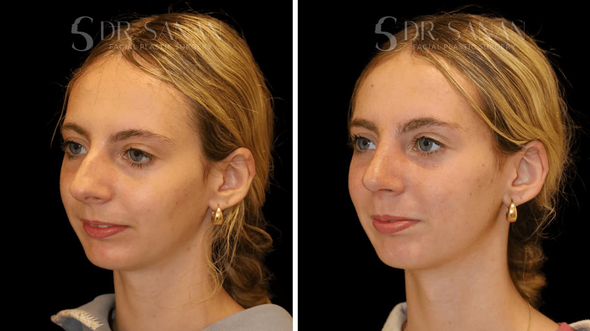 Rhinoplasty Before & After Gallery - Patient 388107 - Image 6