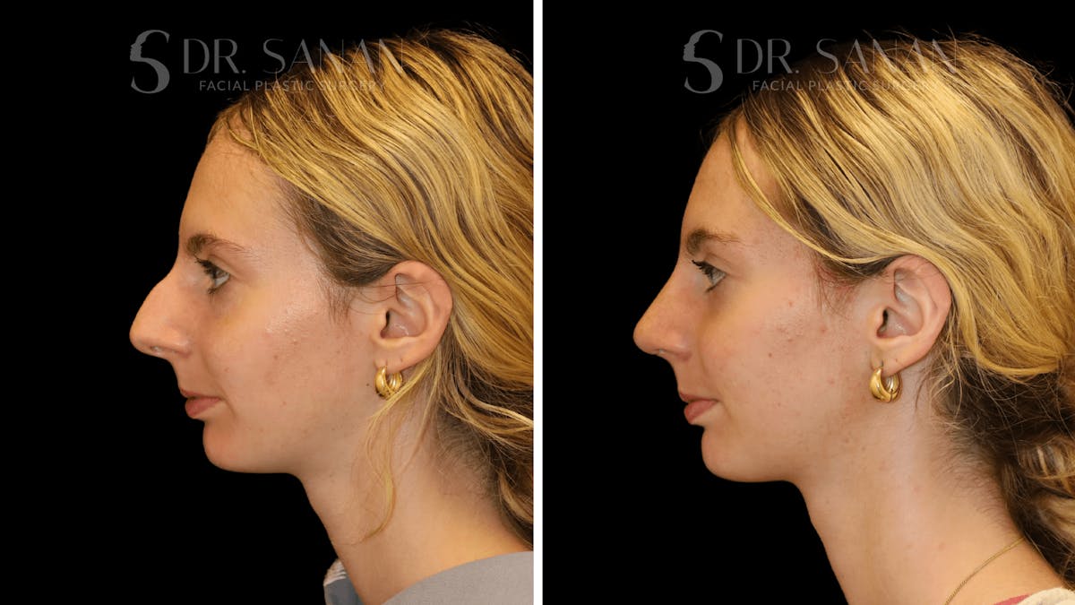 Rhinoplasty Before & After Gallery - Patient 388107 - Image 2