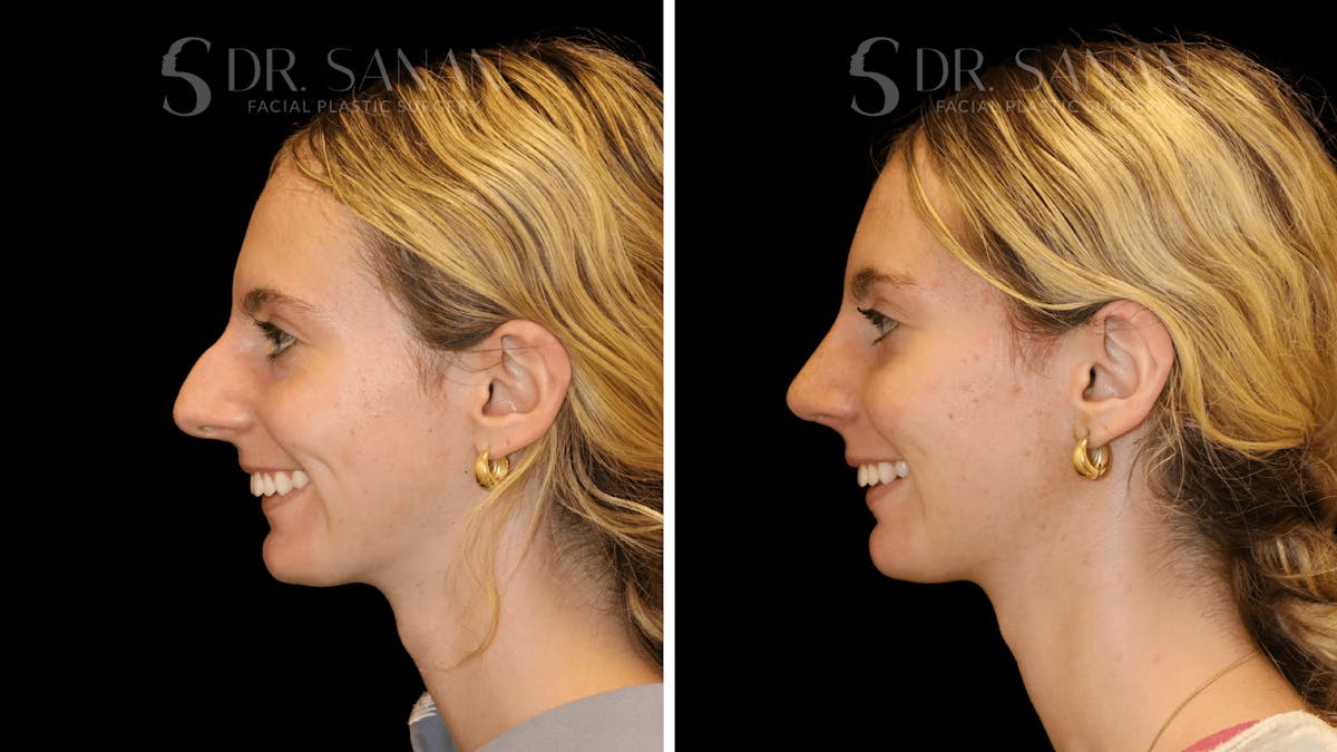 Rhinoplasty Before & After Gallery - Patient 388107 - Image 3