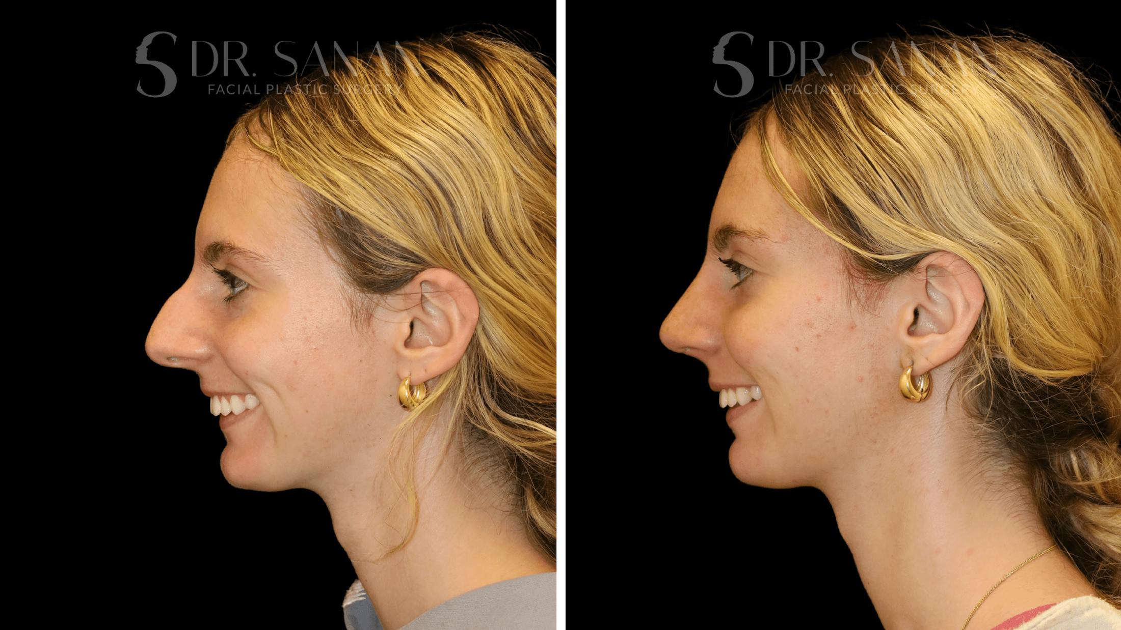Rhinoplasty Before & After Gallery - Patient 388107 - Image 3