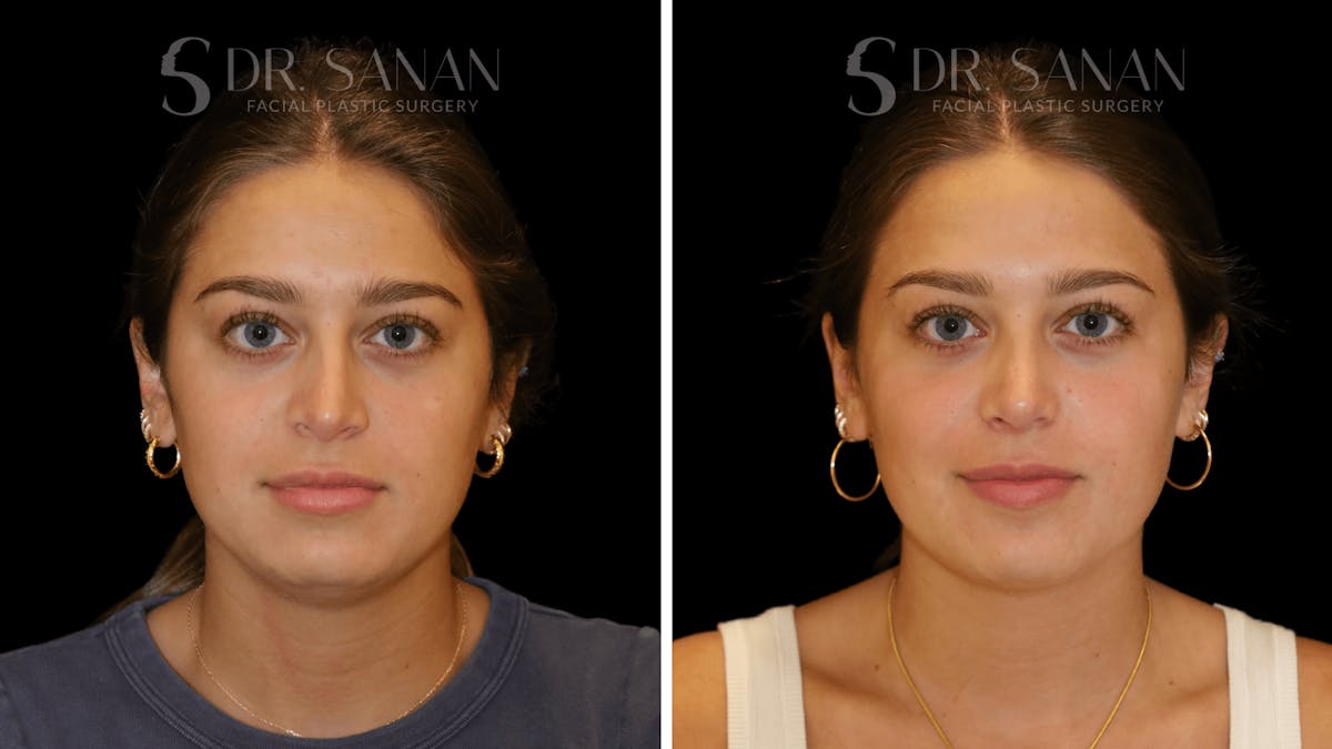 Rhinoplasty Before & After Gallery - Patient 355643 - Image 8