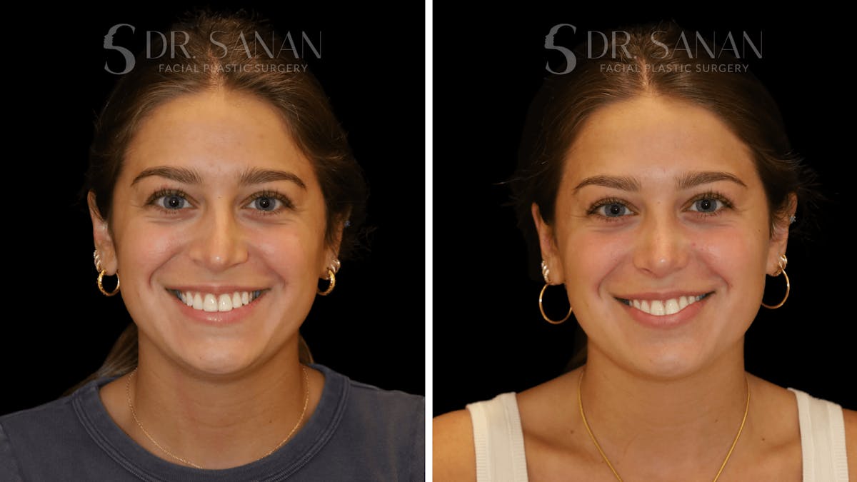 Rhinoplasty Before & After Gallery - Patient 355643 - Image 7