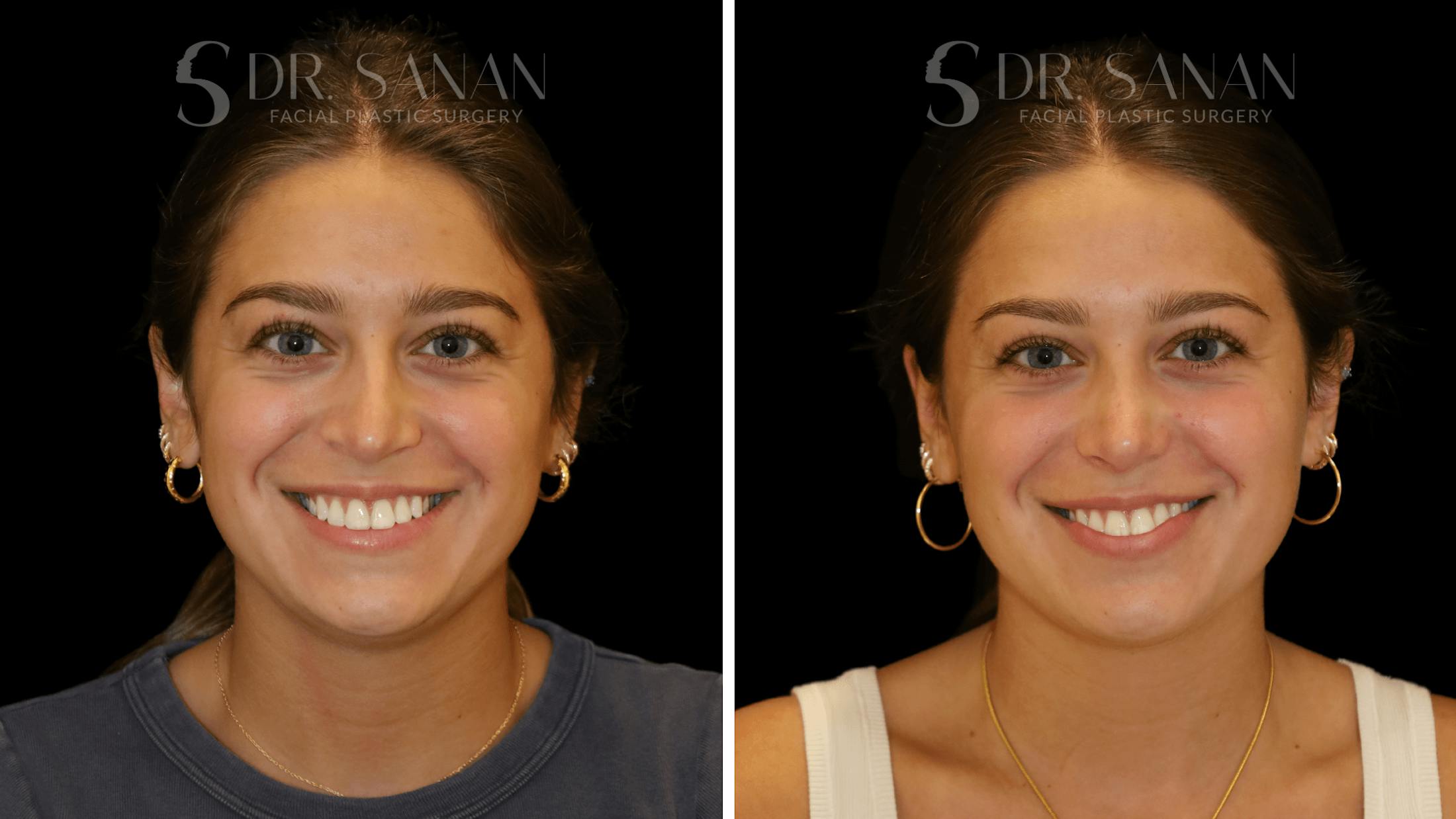 Rhinoplasty Before & After Gallery - Patient 355643 - Image 7