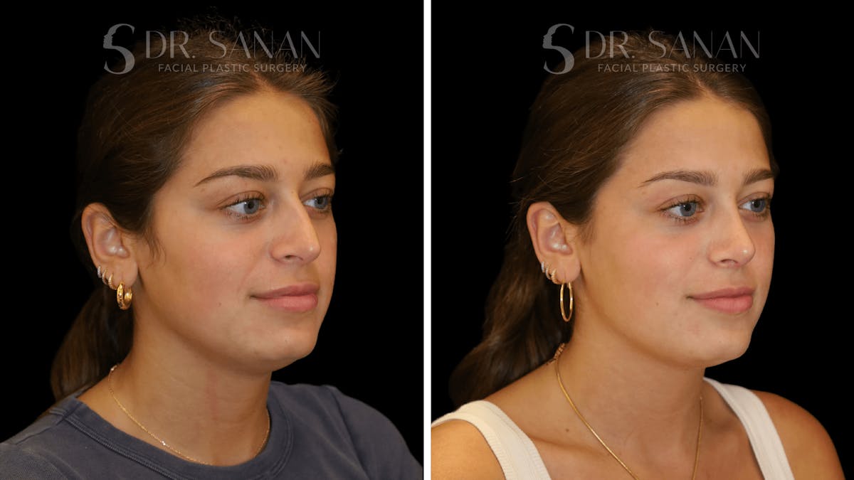 Rhinoplasty Before & After Gallery - Patient 355643 - Image 4