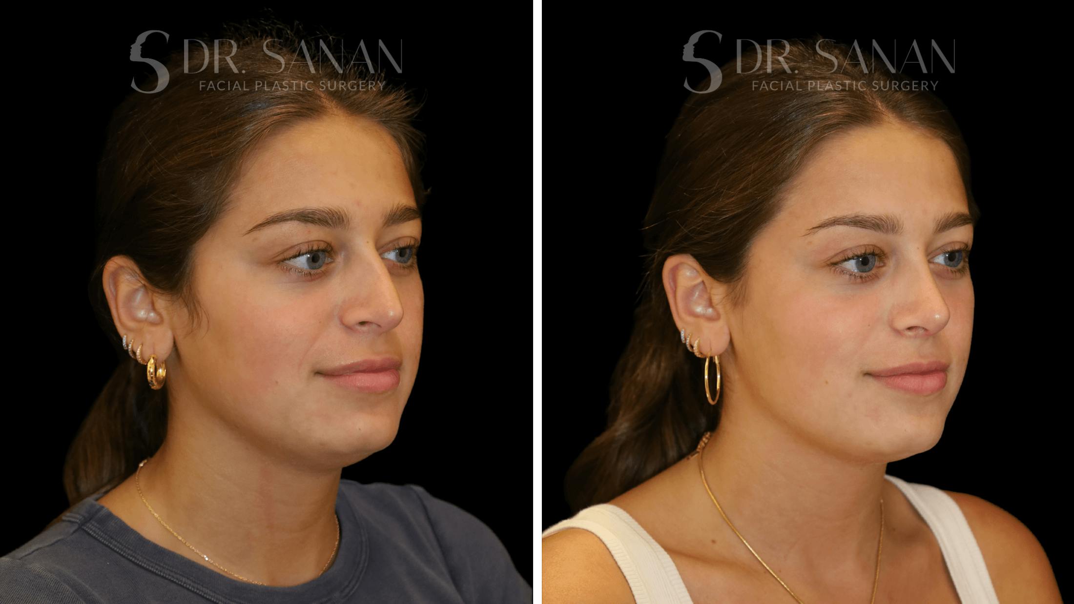 Rhinoplasty Before & After Gallery - Patient 355643 - Image 4