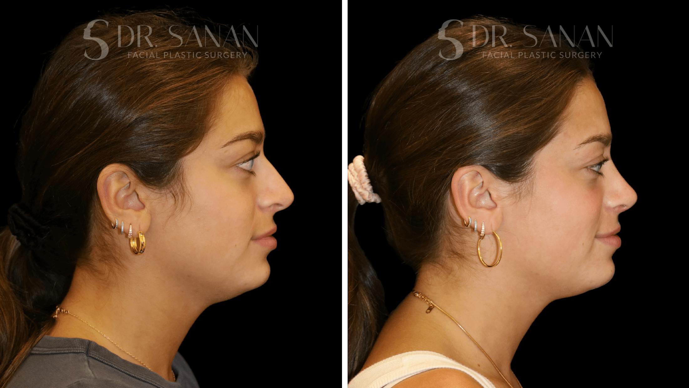 Rhinoplasty Before & After Gallery - Patient 355643 - Image 1