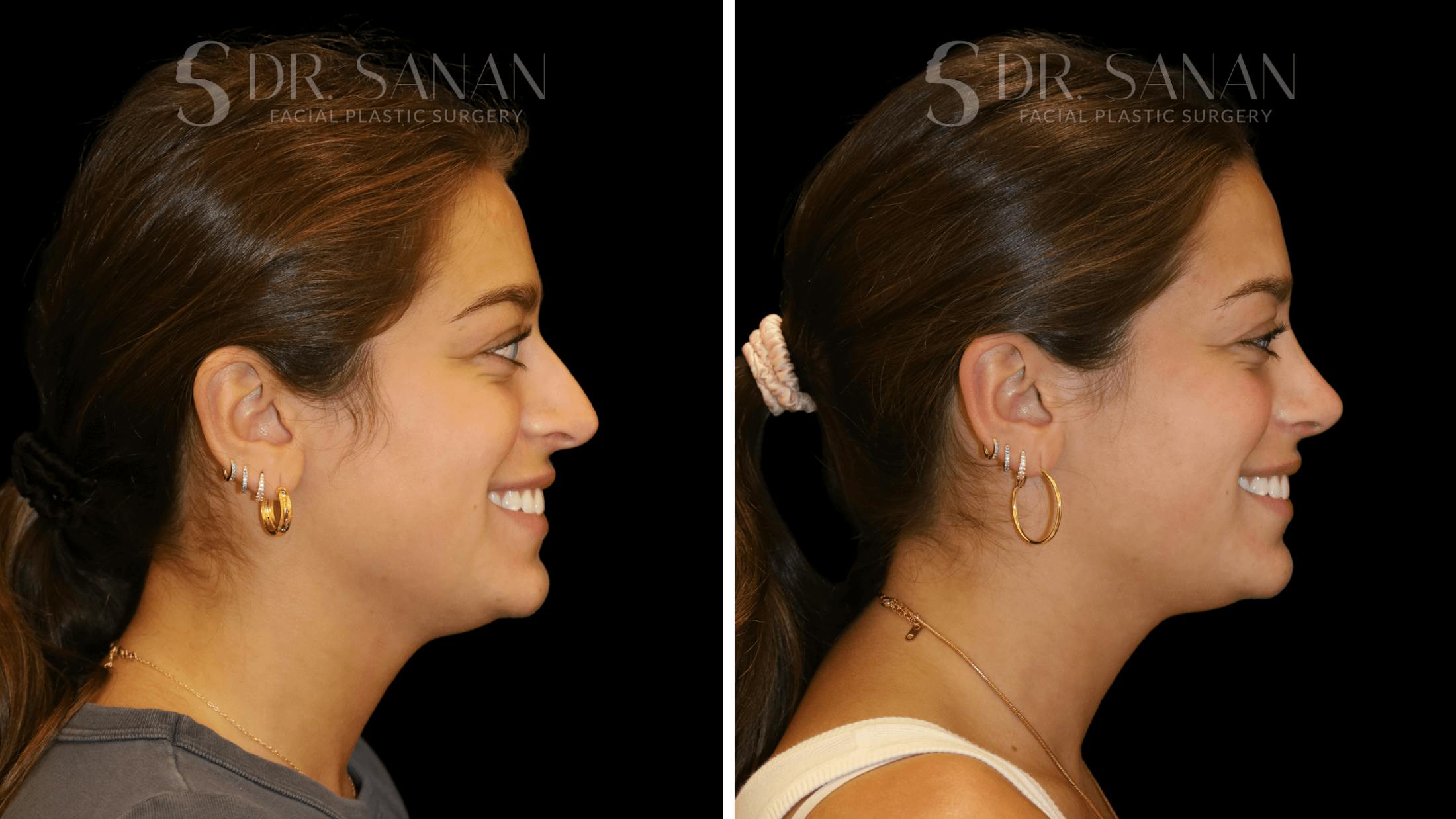 Rhinoplasty Before & After Gallery - Patient 355643 - Image 5