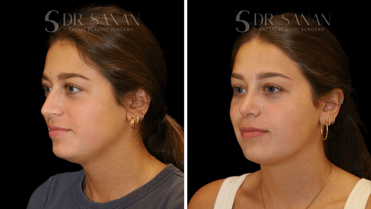 Rhinoplasty Before & After Gallery - Patient 355643 - Image 3