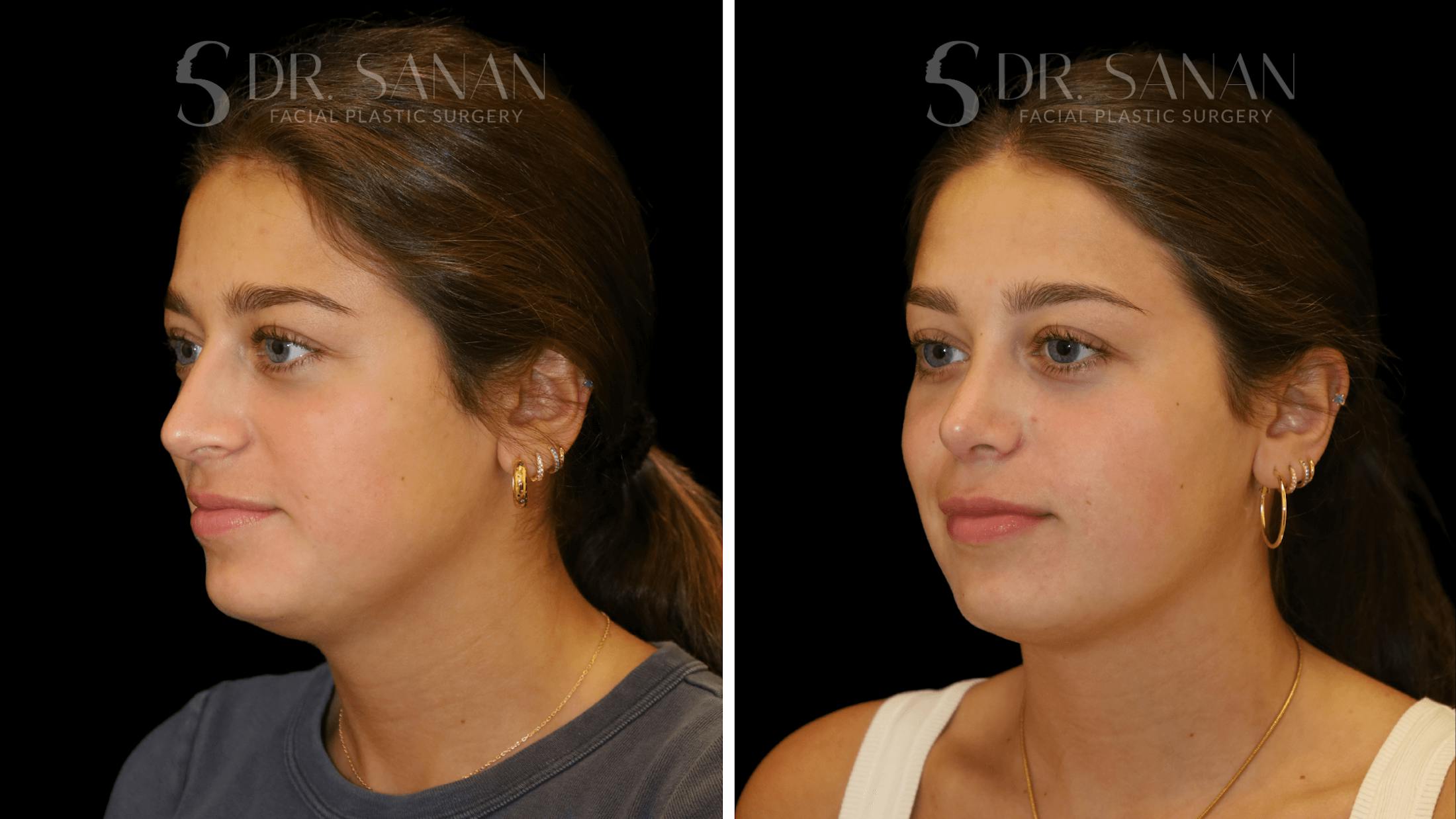 Rhinoplasty Before & After Gallery - Patient 355643 - Image 3