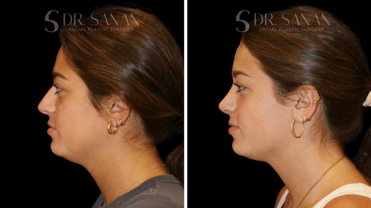 Rhinoplasty Before & After Gallery - Patient 355643 - Image 2