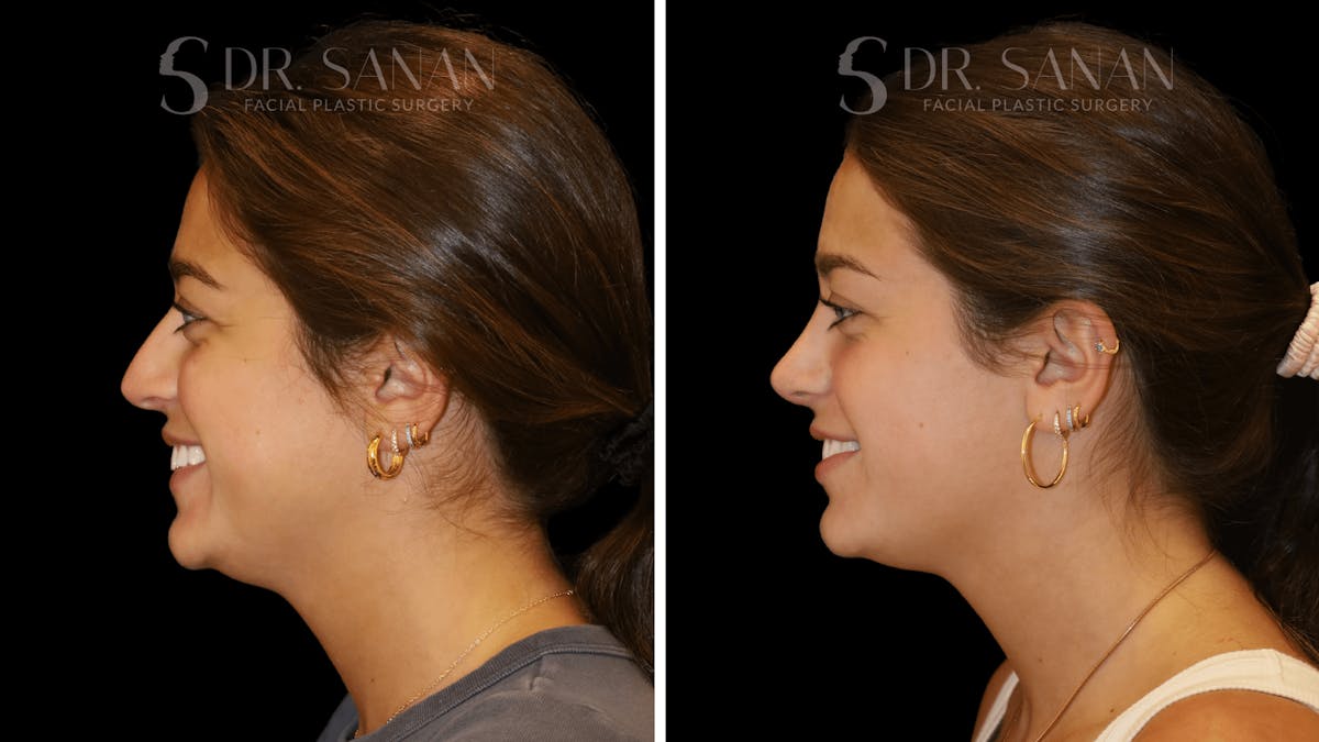 Rhinoplasty Before & After Gallery - Patient 355643 - Image 6