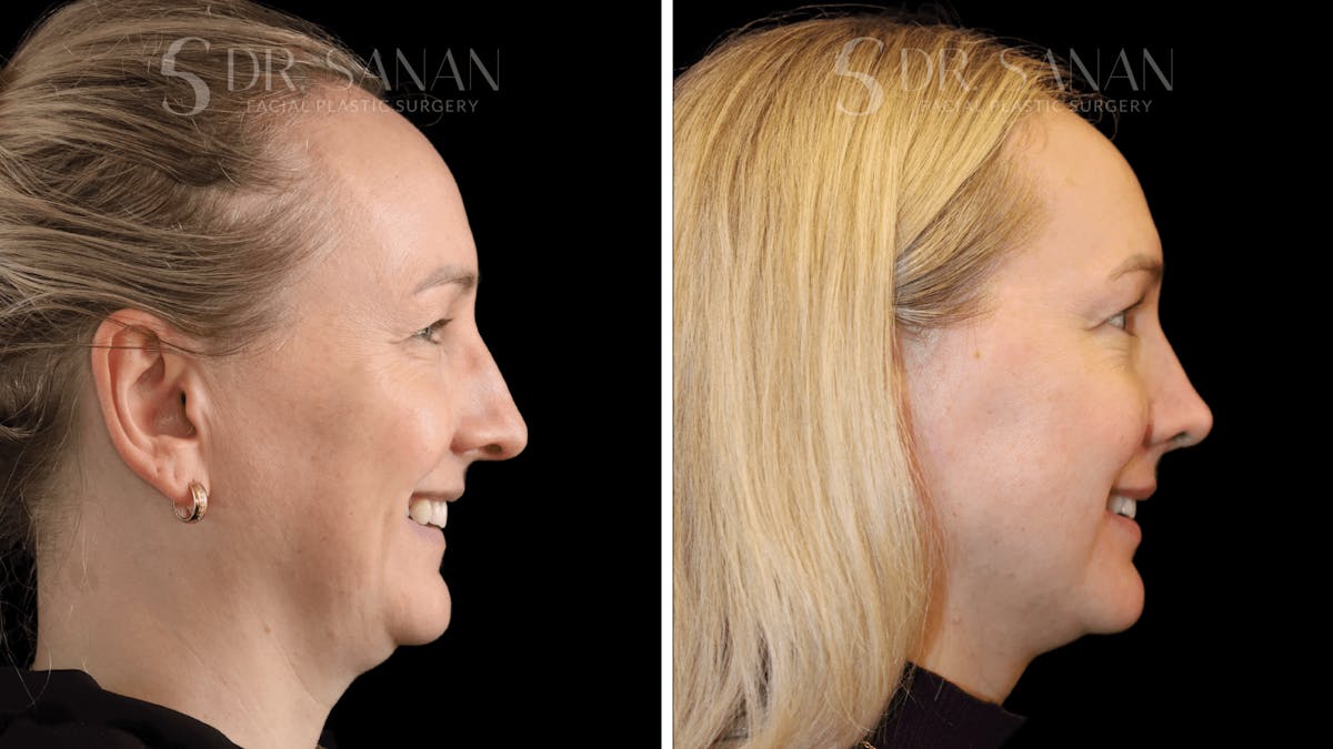 Rhinoplasty Before & After Gallery - Patient 175477 - Image 8