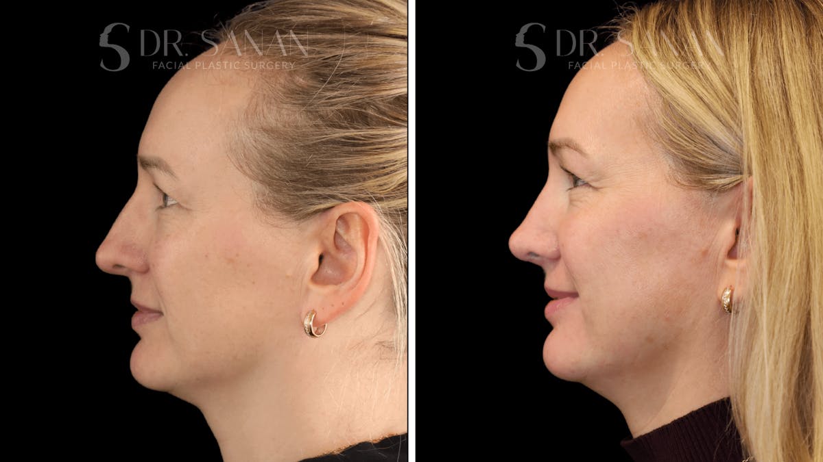 Rhinoplasty Before & After Gallery - Patient 175477 - Image 2