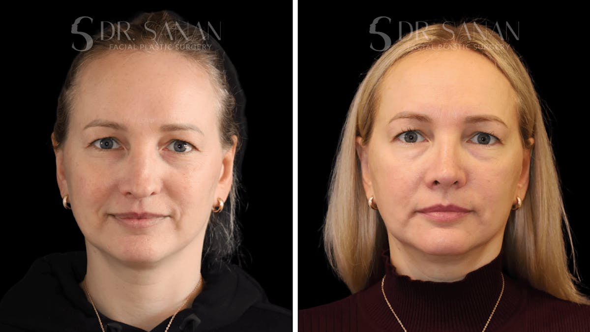 Rhinoplasty Before & After Gallery - Patient 175477 - Image 6